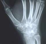 wrist x-ray.jpg
